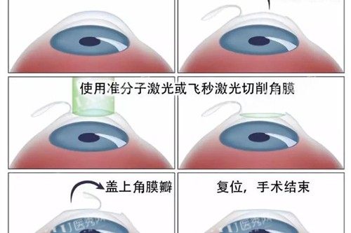 近视眼手术流程展示
