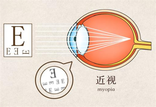 沙米尔离焦镜片怎么样？实测结果、价格、适用人群全揭秘！