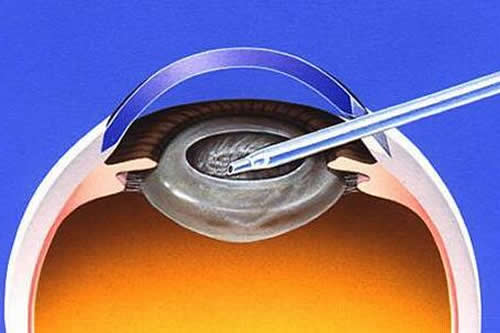 爱尔眼科白内障手术免费政策曝光!哪些人能免费做,各地报销比例大揭秘