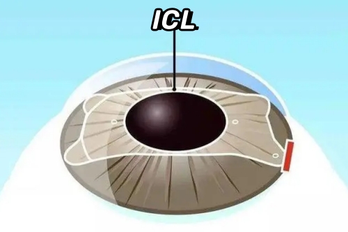纠结!ICL晶体和全飞秒哪个更适合矫正近视?看完这篇全明白!