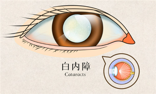 淮阴白内障免费手术申请秘籍大公开!符合这些条件轻松搞定!
