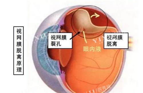 视网膜脱落原理