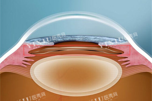 icl晶体植入眼睛漫画图