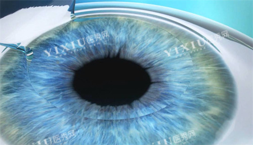 近视手术前眼睛制瓣