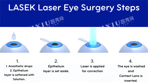 近视手术流程图