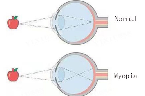 近视眼与正常眼对比