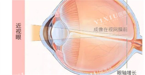 近视眼的成像