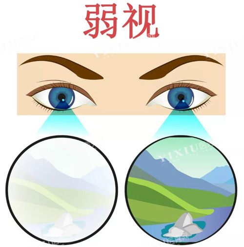 弱视和正常眼镜区别