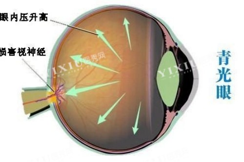 青光眼卡通概念图