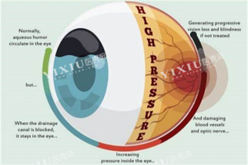 青光眼症状图片