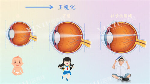近视眼镜轴长与年龄变化示意图