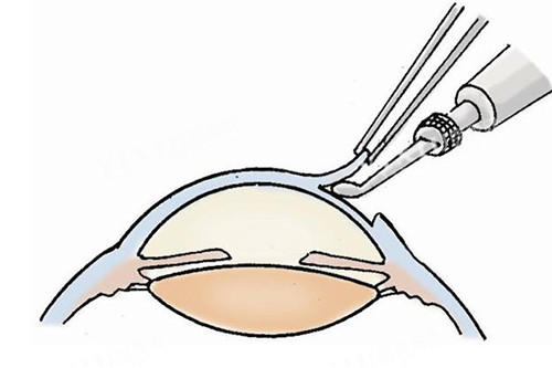 近视手术改善卡通图