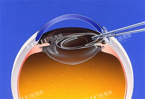 白内障晶体展示图