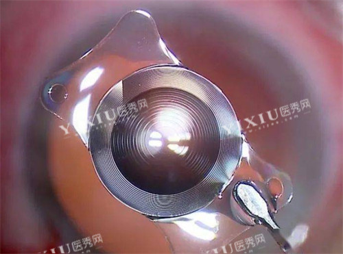 白内障晶体展示