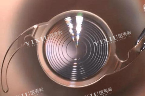 白内障晶体图片