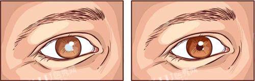 白内障眼睛区别