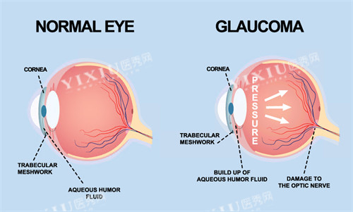 青光眼动画演示图