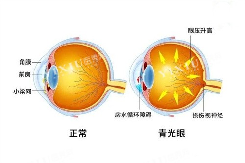 青光眼与正常眼对比图