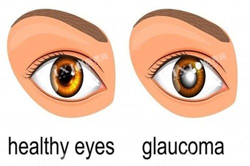 青光眼对比