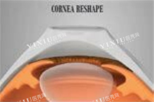 角膜塑形镜3副本