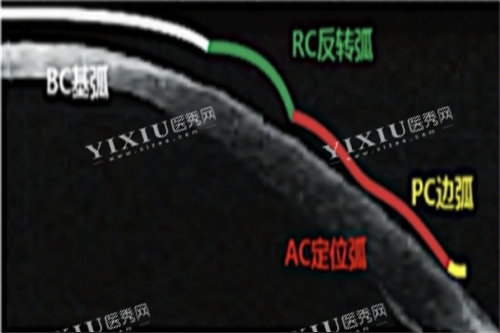 角膜塑形镜各弧区示意图