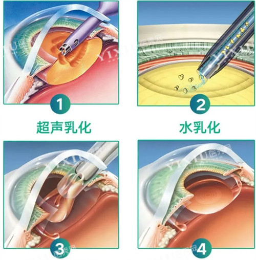超声乳化白内障手术过程