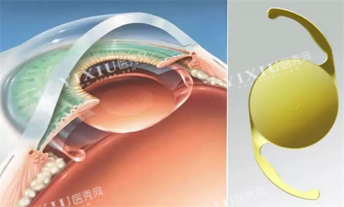 白内障人工晶体的选择