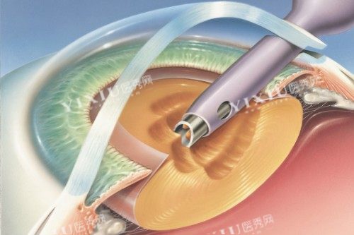 白内障手术
