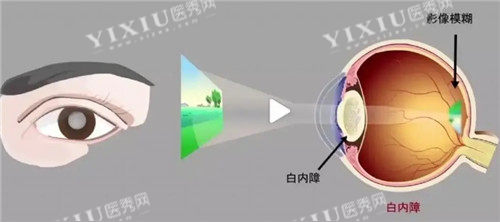 白内障视力表现图