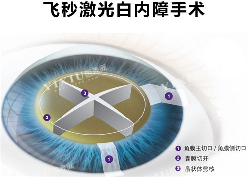 飞秒白内障手术细节图
