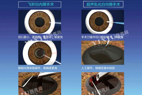 飞秒白内障和超声乳化白内障