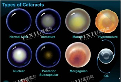 不同白内障晶体展示