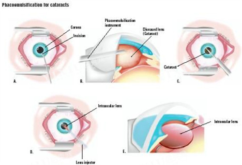 超声乳化白内障吸除术过程