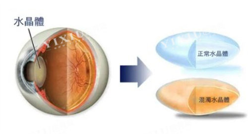 白内障的水晶体