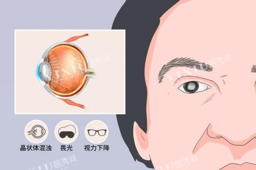 白内障症状卡通图