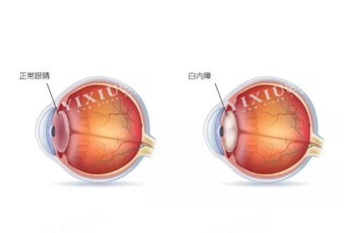 正常眼睛与白内障眼镜对比图