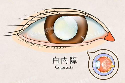白内障卡通示意图