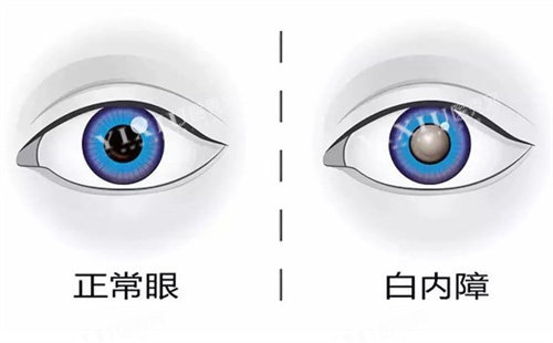 正常眼睛和白内障