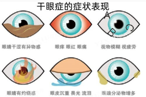 干眼症的症状及表现