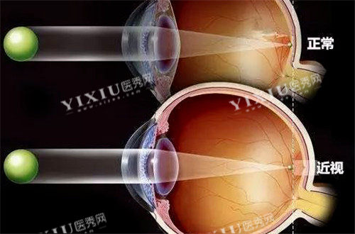 正常视力和近视视力表现图