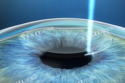 近视手术示意图