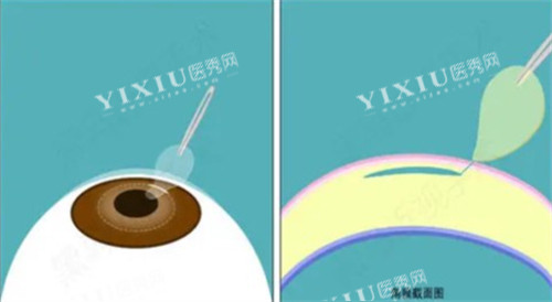 激光近视手术过程图解