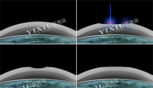 smart激光近视手术过程