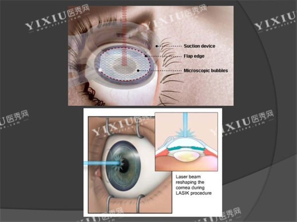 近视眼手术照片